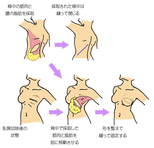 写真：せなかを使う手術