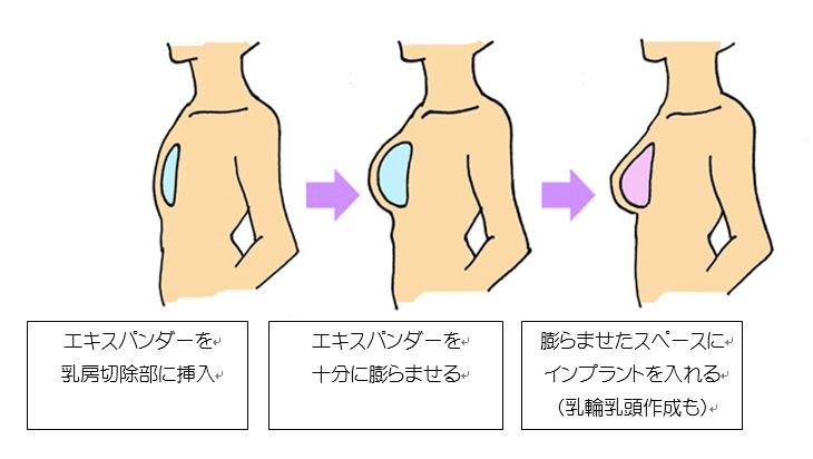 写真：人工乳房